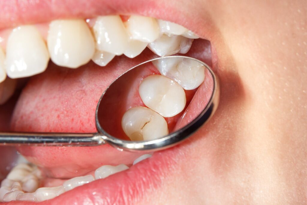 dental fillings in Islamabad G-9 Markaz